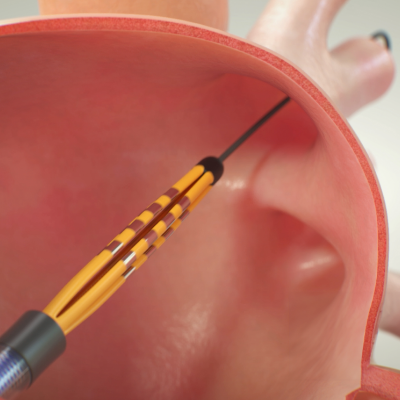 Descubra y conozca cómo funciona el sistema de PFA.