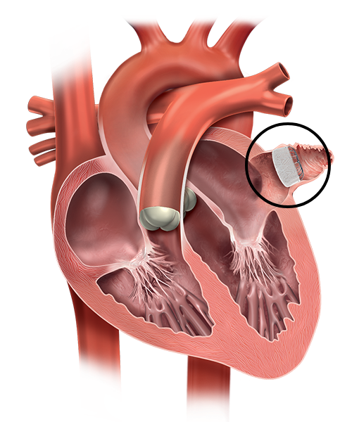Obtenga más información sobre el cierre de la orejuela auricular izquierda.