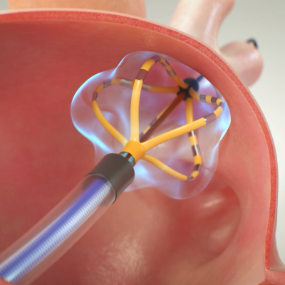 Descubra y conozca cómo funciona el sistema de PFA.